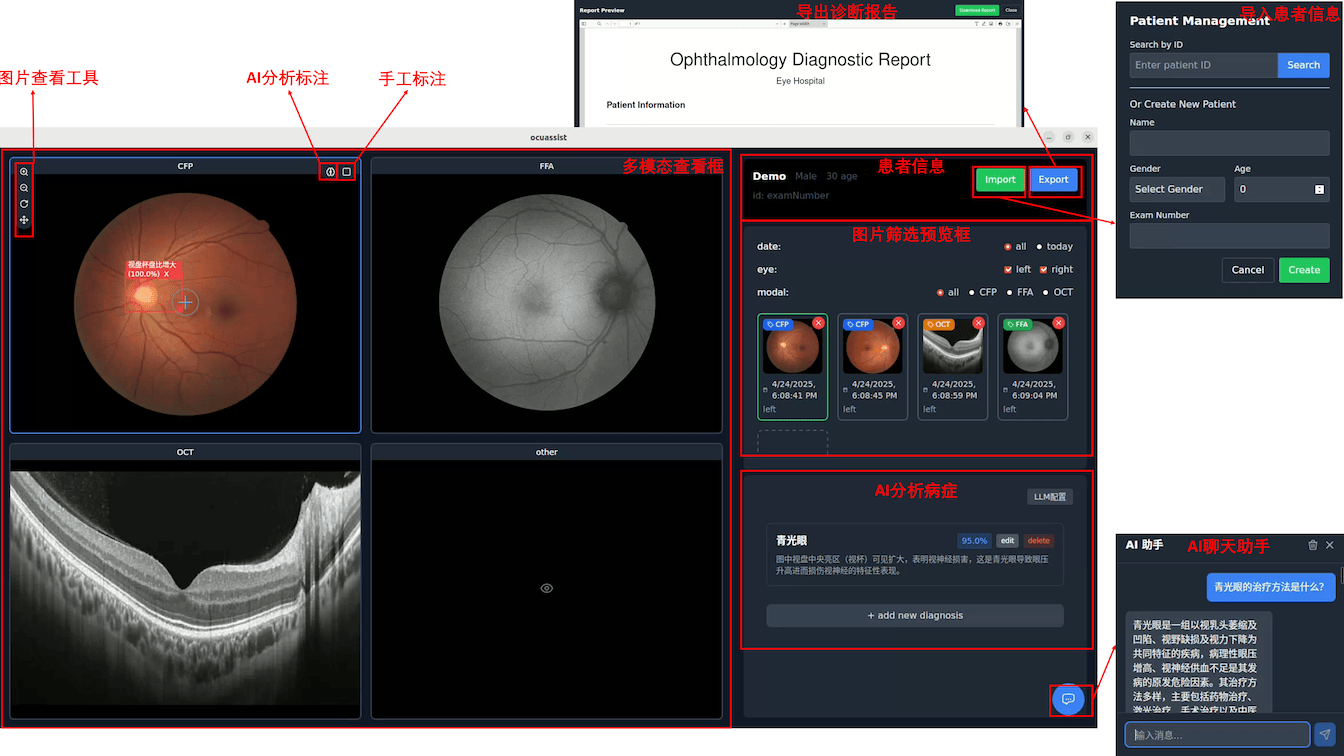 OcuAssist :AI辅助眼底多模态诊断系统,为眼科医生提供诊断支持